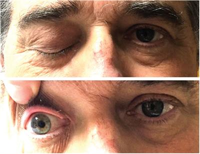 Merkel Cell Carcinoma with Distant Metastasis to the Clivus Causing Symptoms Mimicking Tolosa–Hunt Syndrome: A Case Report and Literature Review